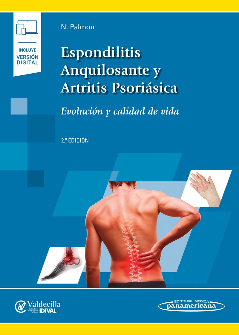 Espondilitis Anquilosante Y Artritis Psoriásica Evaluación Y Calidad De Vida Incluye Ebook