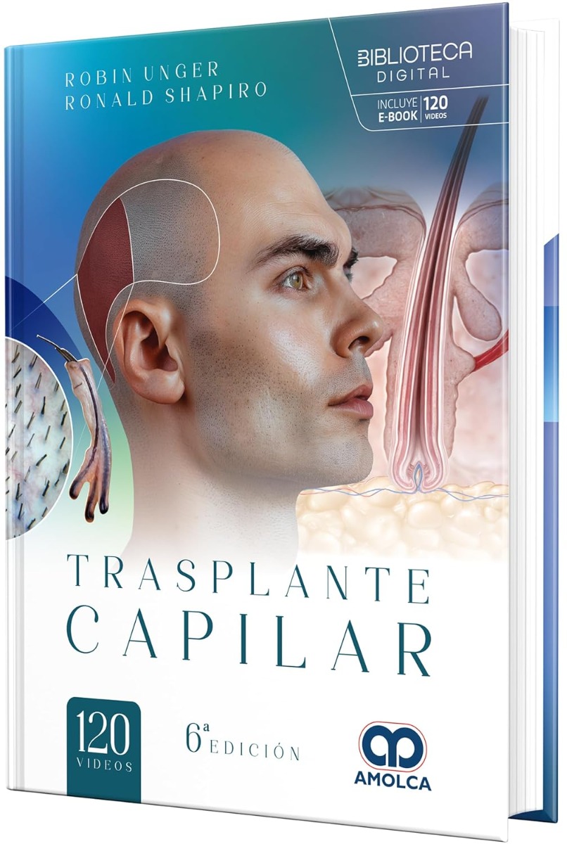 Trasplante Capilar
