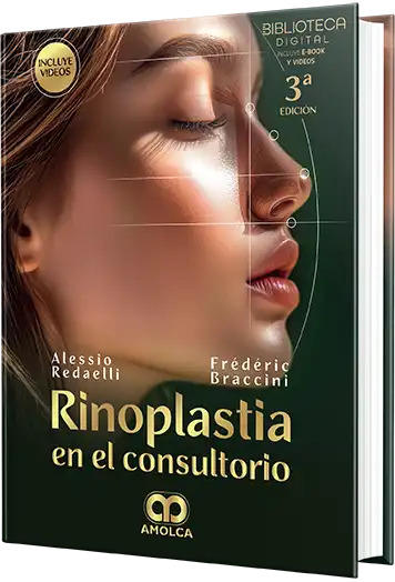 Rinoplastia en el Consultorio