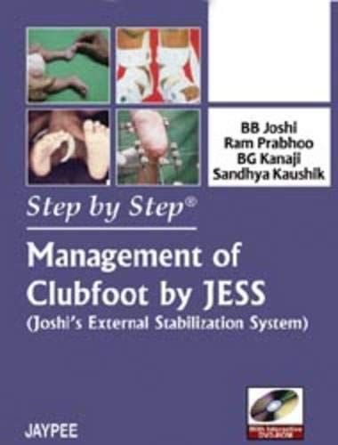 Step by Step Management of Clubfoot by Jess: Joshi's External Stabilization System