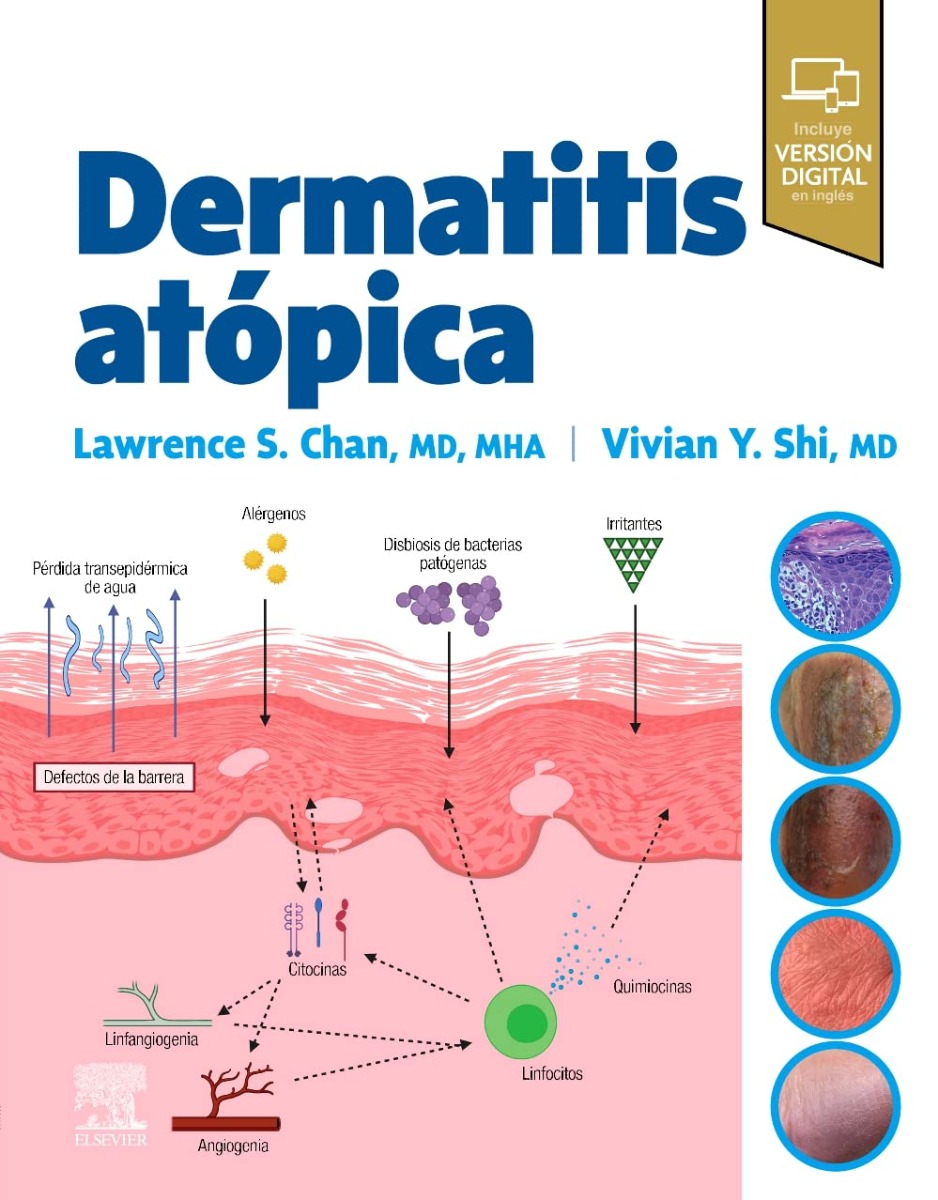 Dermatitis Atópica