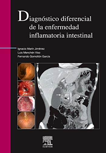 Diagnóstico diferencial de la enfermedad inflamatoria intestinal