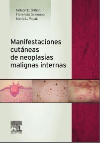 Manifestaciones Cutáneas De Neoplasias Malignas Internas