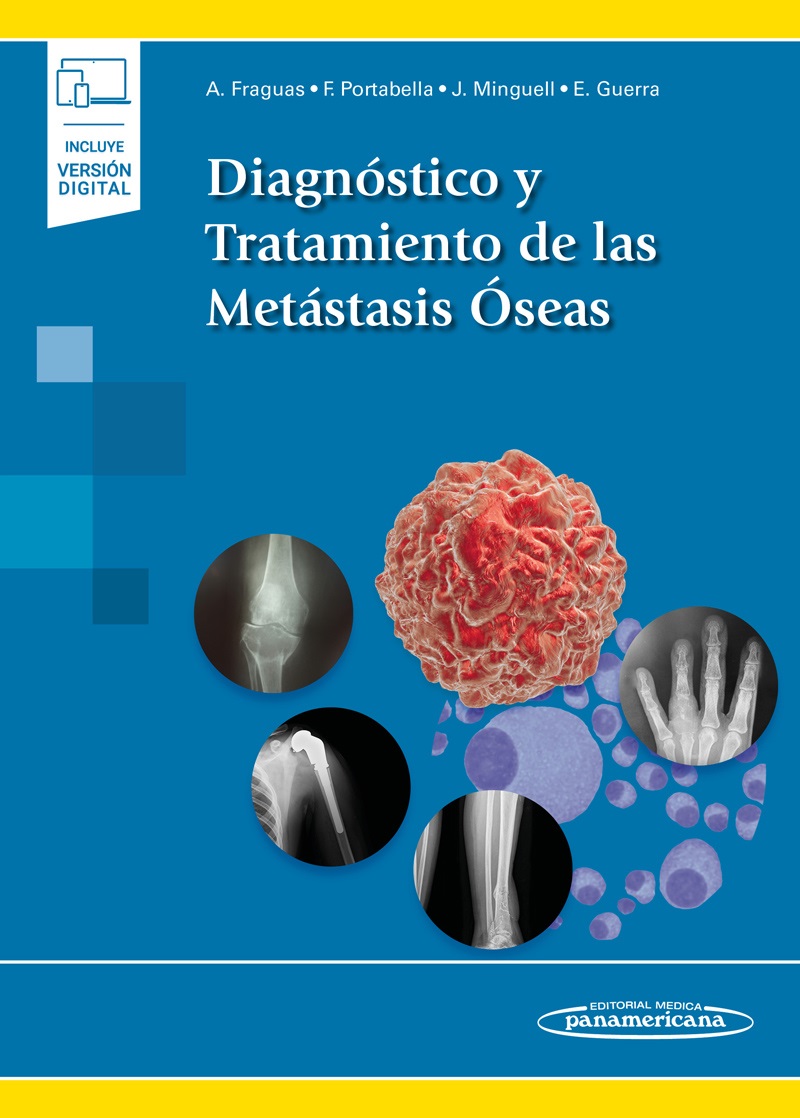 Diagnóstico Y Tratamiento De Las Metástasis Óseas (Incluye Versión Digital)