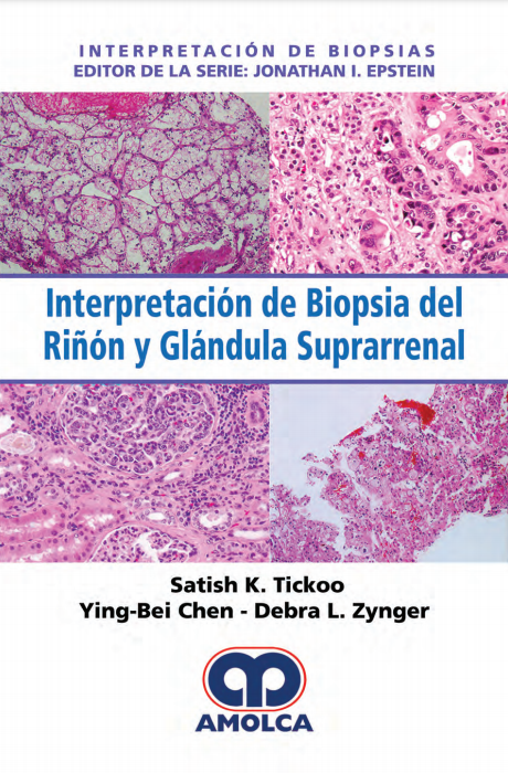 Interpretación de Biopsia del Riñón y Glándula Suprarrenal