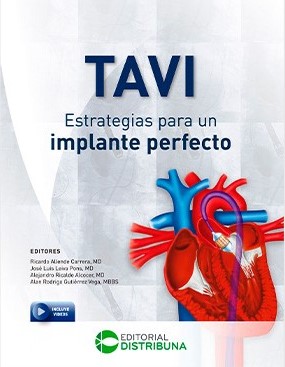 Tavi: Estrategias Para Un Implante Perfecto