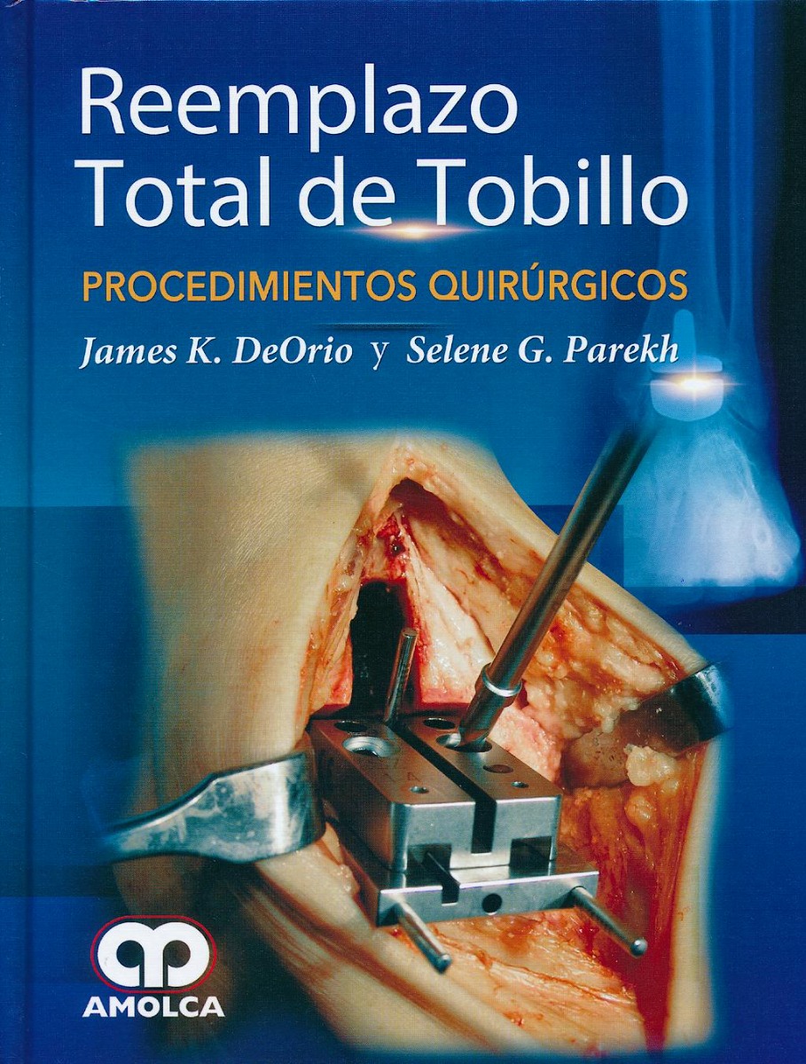 Reemplazo Total de Tobillo. Procedimientos Quirúrgicos