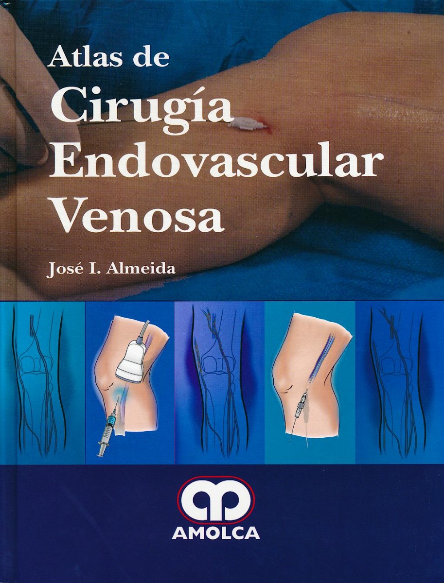 Atlas de Cirugia Endovascular Venosa