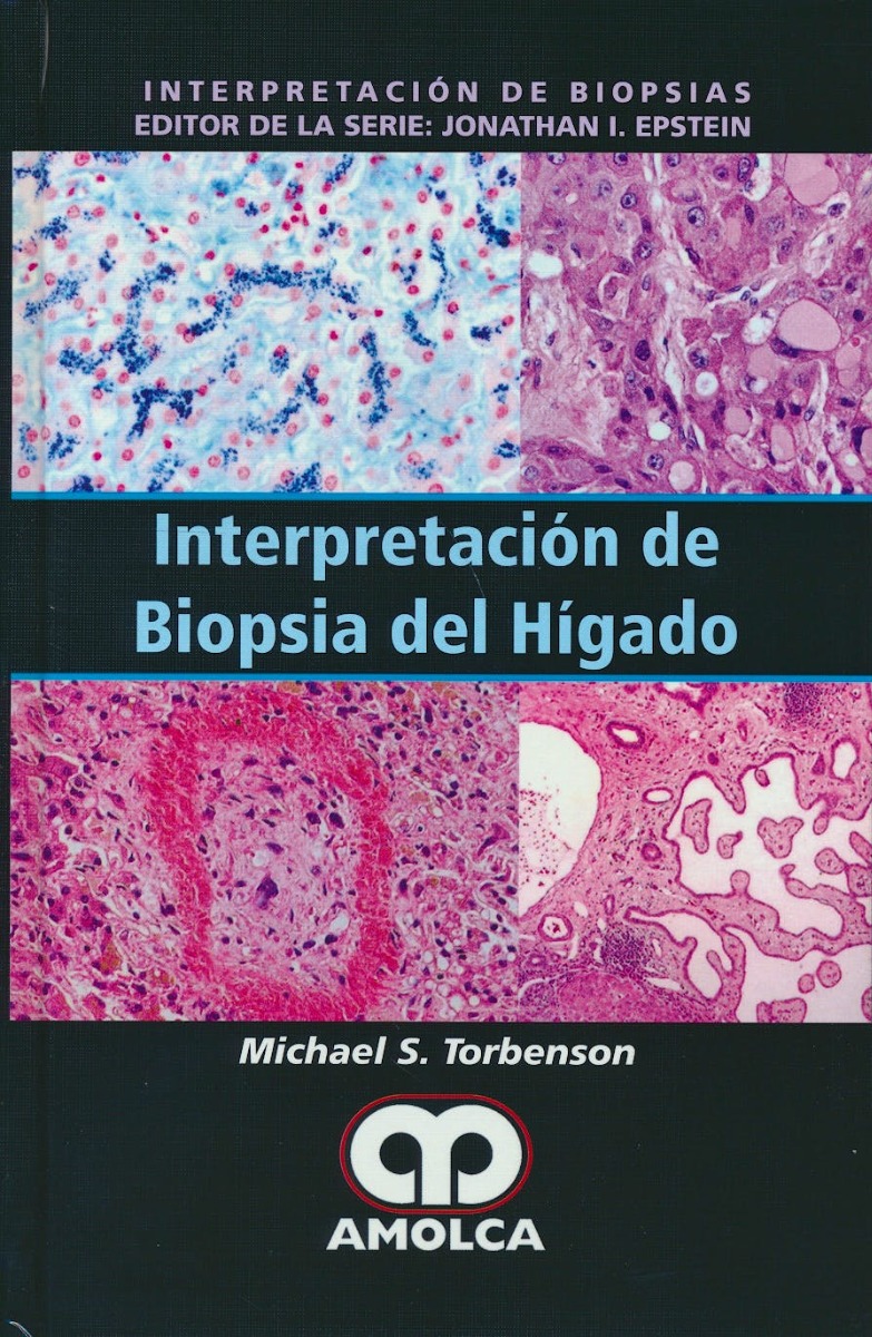 Interpretación de Biopsia del Hígado