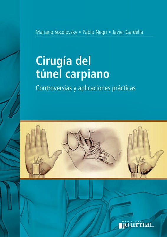 Cirugía del Túnel Carpiano