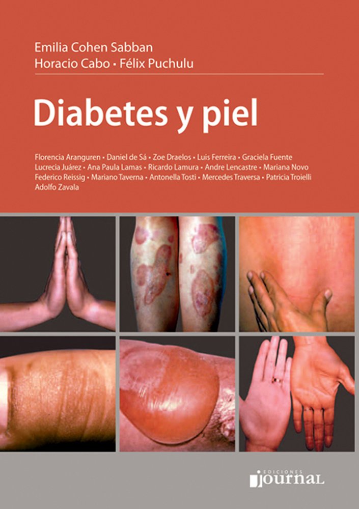  Diabetes y Piel