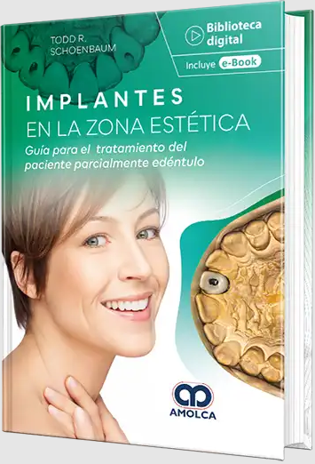 Implantes en la zona estética