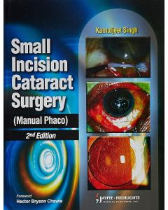 Small Incision Cataract Surgery 