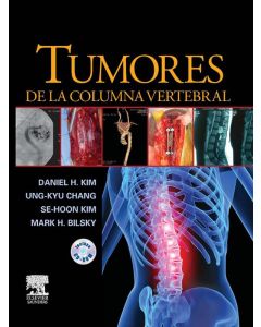 Tumores de la columna vertebral