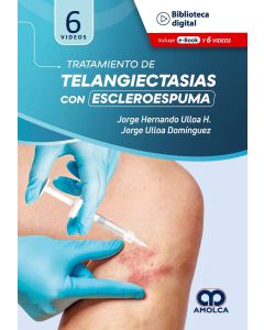Tratamiento de Telangiectasias con Escleroespuma