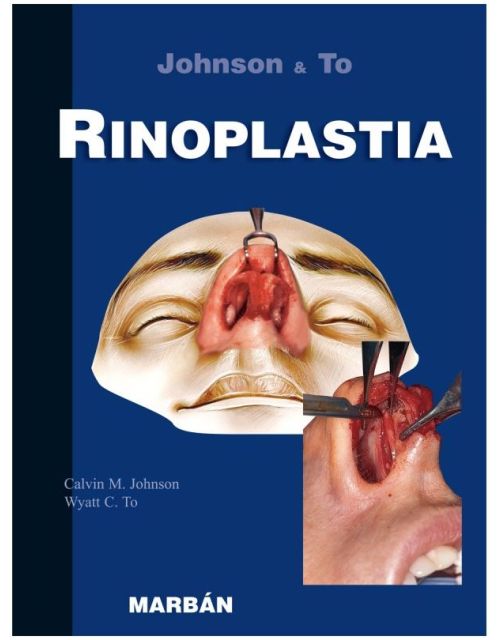 Rinoplastia