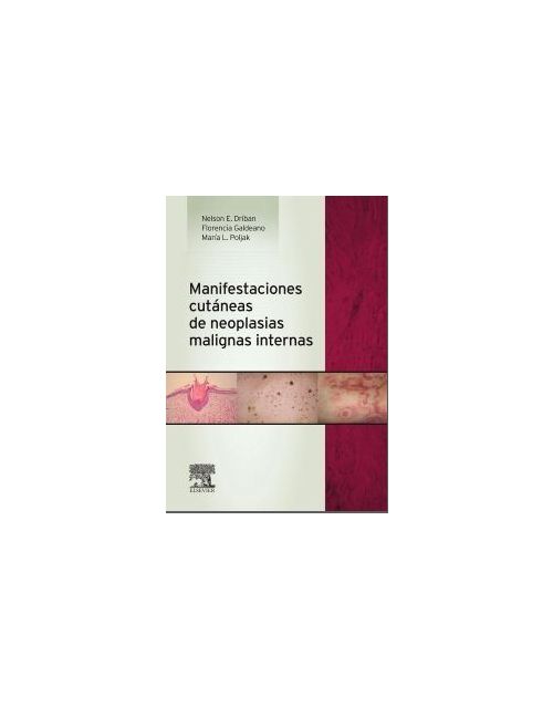 Manifestaciones Cutáneas De Neoplasias Malignas Internas