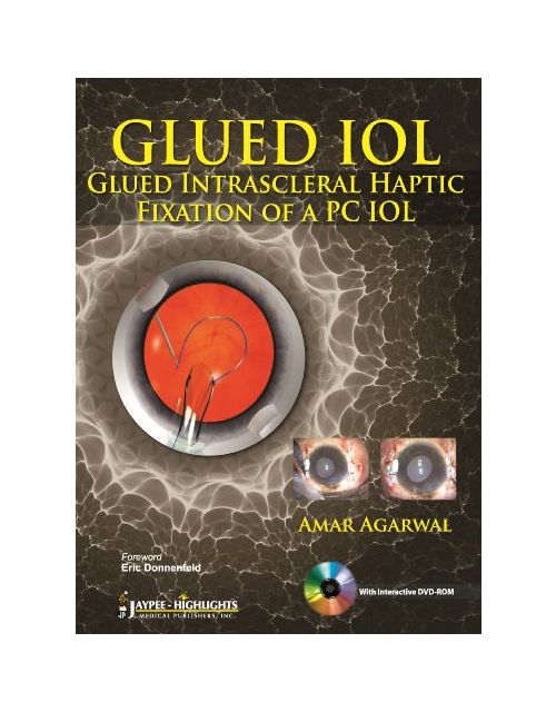 GLUED IOL: Glued Intrascleral Haptic Fixation of a PC IOL
