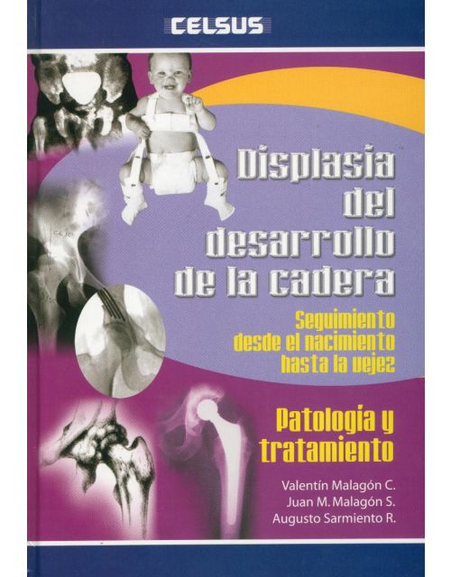 Displasia Del Desarrollo De La Cadera