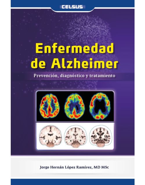 Enfermedad de Alzheimer