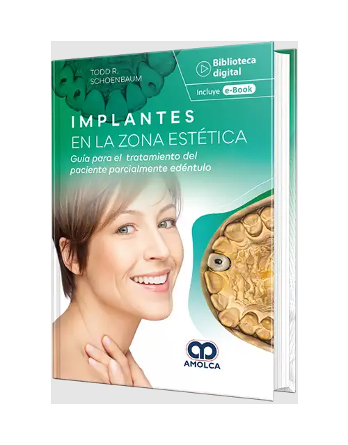 Implantes en la zona estética